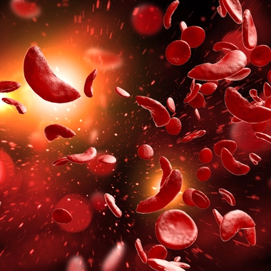 La drépanocytose est une maladie du sang qui affecte les globules rouges