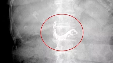 La patiente s'est retrouvée avec son dentier dans l'estomac