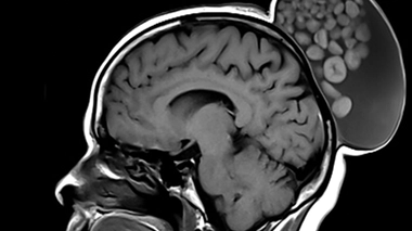 Le kyste mesurait plus de 15 cm de long et était parfaitement indolore pour la patiente