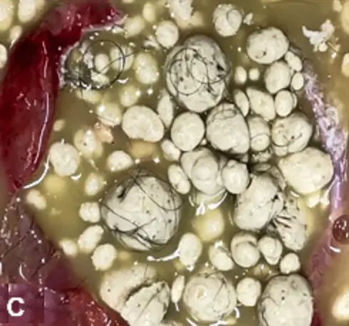 Contenu du kyste de la patiente après ablation