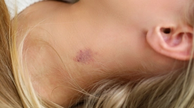 L'aspiration intense d'un suçon peut léser une artère du cou et provoquer un caillot