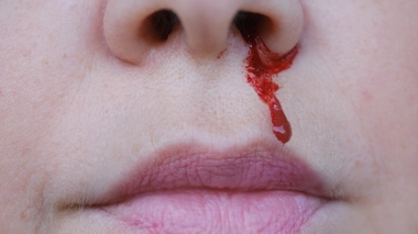 Comment réagir en cas de saignement de nez ?