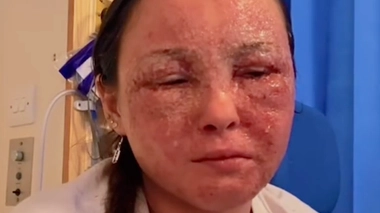 Sur son compte TikTok, Beatrice Gaucahas revient sur sa pire poussée d'eczéma