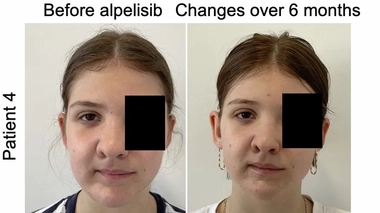 Cinq patients ont à ce jour testé ce traitement avec des résultats impressionnants