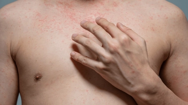 Depuis 2022, le nombre de cas de rougeole est en hausse, ce qui inquiète l'ARS