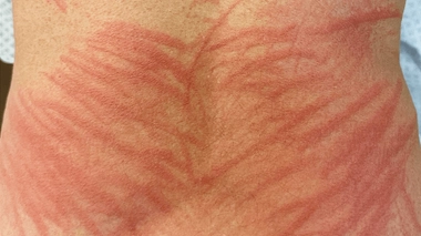 Mal cuits, les champignons shiitakes peuvent causer de sévères réactions allergiques