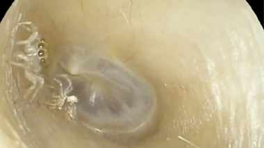 L'araignée, mesurant entre 2 et 3 mm, a mué dans le conduit auditif de la femme