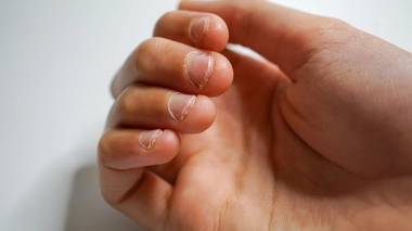 Se ronger les ongles peut-être le signe d'une angoisse ou d'un stress.