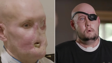 Selon une chirurgienne américaine, il est peu probable qu’Aaron James recouvre la vue grâce à cette greffe