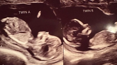 Selon la gynécologue de la jeune femme, il est probable "que les spermatozoïdes soient remontés dans chaque utérus et que la fécondation ait eu lieu séparément"