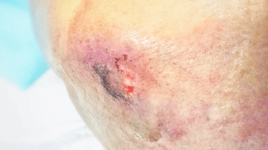 Comment éviter l'apparition d'escarre