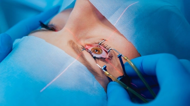 Opération de la myopie : quels sont les risques ?