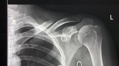 Fractures, nodules... quand l'intelligence artificielle participe au diagnostic