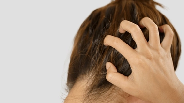 La dermite séborrhéique, une pathologie qui touche 1 à 3 % de la population, qui est une forme d’eczéma.