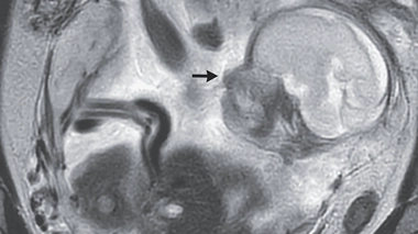 Naissance exceptionnelle d’un bébé après 29 semaines dans l’abdomen de sa mère