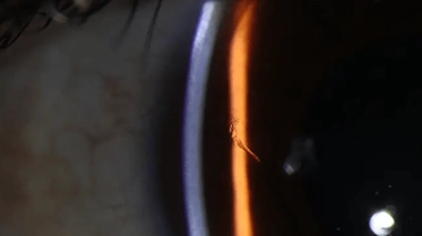 L'écharde n'a finalement pas été retirée, malgré l'intervention d'une équipe d'ophtalmologues