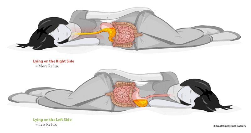 Dormir sur le côté gauche provoque moins de reflux gastriques