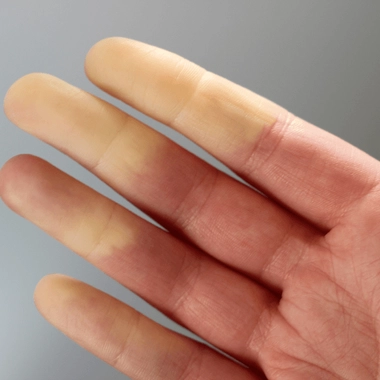 La maladie de Raynaud se manifeste par un blanchiment des doigts quand la température baisse