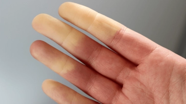 La maladie de Raynaud se manifeste par un blanchiment des doigts quand la température baisse