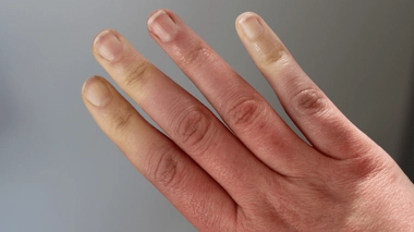 La maladie de Raynaud est particulièrement fréquente chez les jeunes femmes de moins de 30 ans