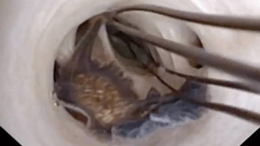 Cinq vers plats parasites ont été trouvés dans les voies biliaires du patient