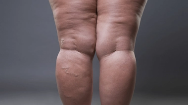 Le lipœdème est une pathologie génétique douloureuse qui provoque une accumulation de graisse autour des jambes. 