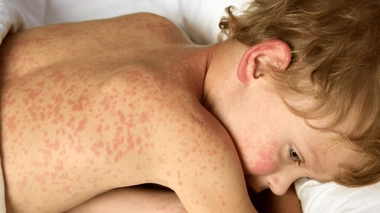 La Rougeole peut toucher toutes les classes d'âges, mais les enfants restent les plus touchés