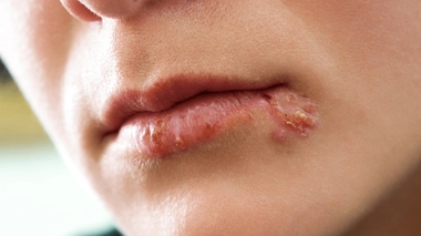 L’herpès labial ou bouton de fièvre est une éruption en forme de "bouquet" de vésicules sur une lèvre, due à un virus. 