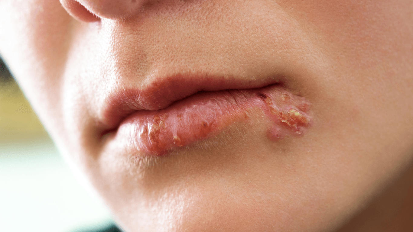 Comment se débarrasser d'un bouton de fièvre ? Allo Docteurs — free download