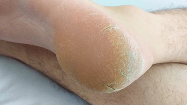 La corne, callosité ou hyperkératose est un épaississement de la peau causé principalement par la pression ou le frottement répété. 