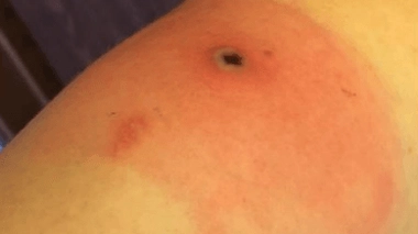 L'Alaskapox provoque des lésions cutanées