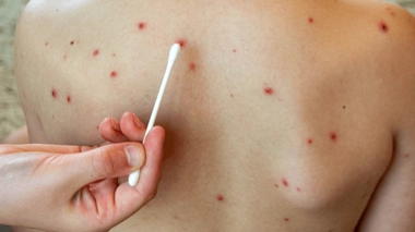La rougeole touche de plus en plus de pays