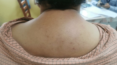 Comment se débarrasser de la bosse de bison ?