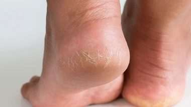 Comment soigner une crevasse au talon ?