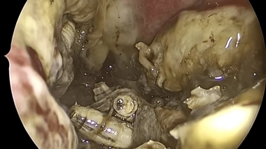 150 vers ont été retrouvés dans la cavité nasale du patient