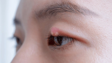 Orgelet et chalazion : quelles différences ?