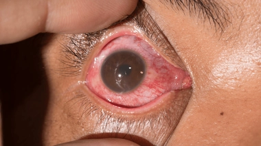 Qu'est-ce qu'une uvéite et comment s'en débarrasser ?