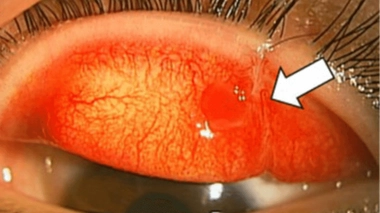 Le "syndrome de la dent canine" est un rare désalignement des yeux qui peut survenir après une morsure traumatique d'animal au niveau de la paupière supérieure des yeux