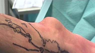 Ch@t : les phlébites