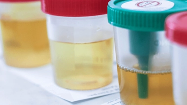 Quelles sont les causes d'une urine qui sent fort