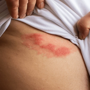 Le zona se manifeste par l'apparition de boutons le long du trajet d'un nerf