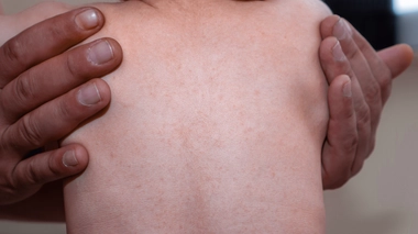 Environ un enfant sur trois est touché par la roséole