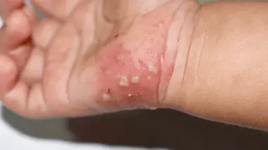 La gale revient, et contrairement à certaines croyances, cette maladie ancestrale n’a pas disparu.