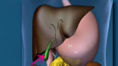 L'Afinitor® autorisé contre le cancer du pancréas