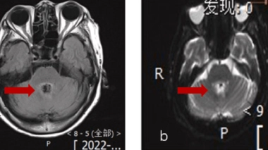 Une lésion dans le cerveau est visible sur les examens