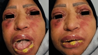 Une femme de 45 ans en soins intensifs après une violente réaction à l’ibuprofène