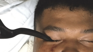 Le frein a miraculeusement évité la pupille et les nerfs vitaux, évitant ainsi des dommages nerveux à long terme