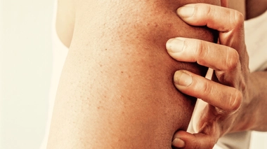 La kératose pilaire est une pathologie cutanée courante, bénigne et non contagieuse