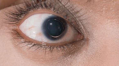 Le syndrome de Marfan peut entraîner des symptômes au niveau de l'oeil