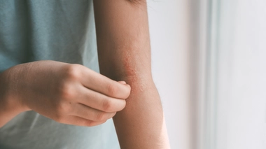 En France, l’eczéma atopique touche 2,5 millions de personnes